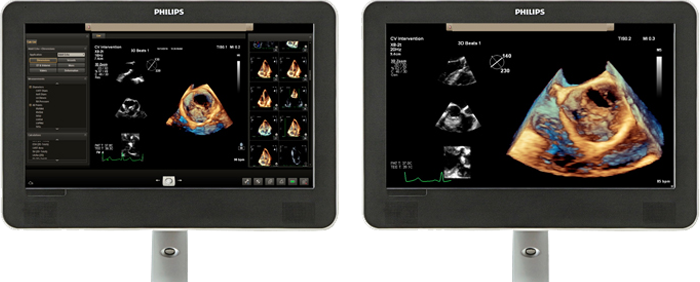 心臓超音波画像の表示領域の比較。