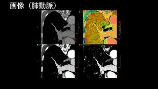 IQon Spectral CT クリニカル・ケース case 73: 肺動脈末梢の血栓塞栓症の評価