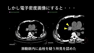 IQon Spectral CT クリニカル・ケース case 74: 単純画像から肺塞栓症を見つける