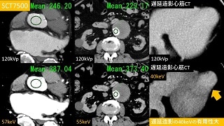 Spectral CT クリニカル・ケース case80
