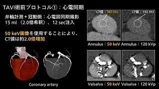 Spectral CT クリニカル・ケース case83