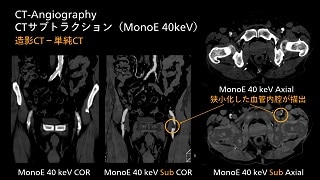 Spectral CT クリニカル・ケース case84