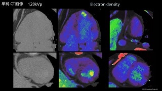 Spectral CT クリニカル・ケース case 90