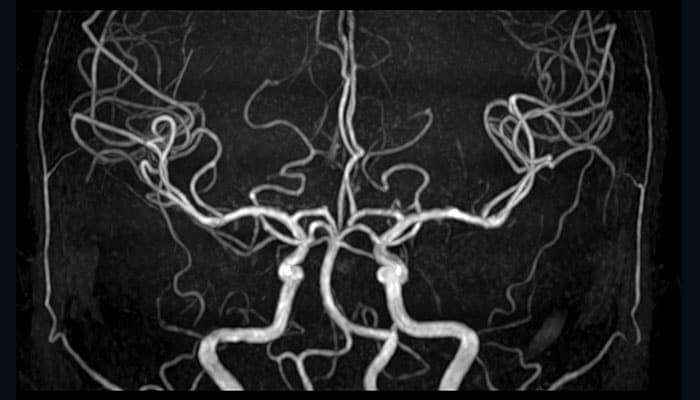 Neuro - Head Neck TOF MRA