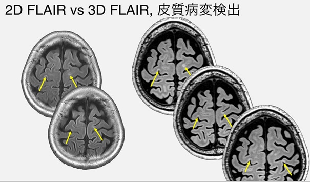 皮質病変における2Dと3Dの検出能の比較