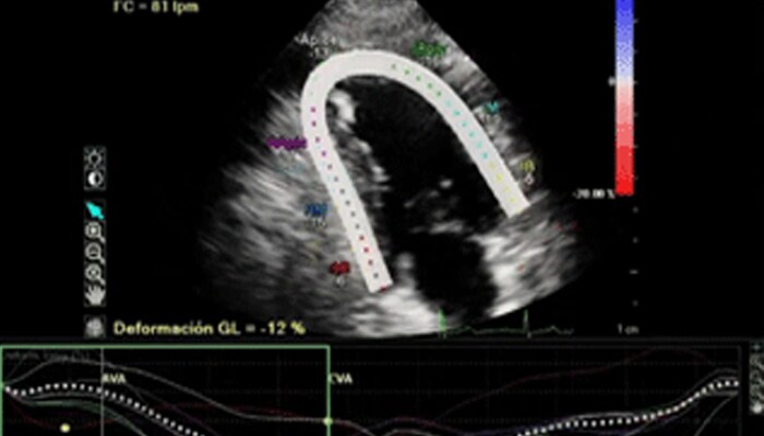 Hypertension and Heart Failure