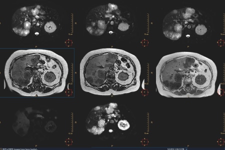 マルチモダリティ方式の腫瘍のトラッキング image