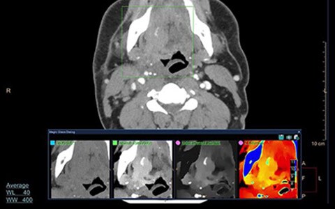 spectral CTで診断の確度が向上