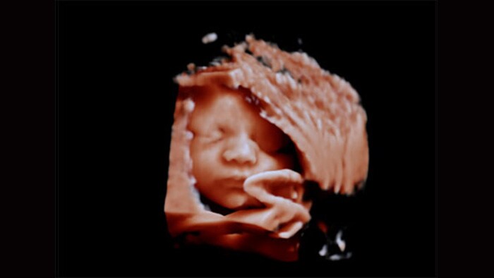 Philips Affiniti超音波診断装置 胎児の顔 aReveal未適用