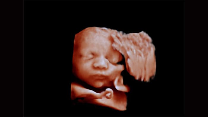 Philips Affiniti超音波診断装置 胎児の顔 aReveal適用