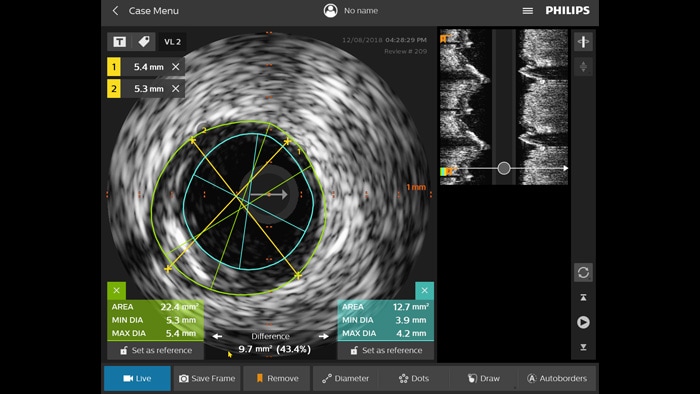 血管内超音波検査（IVUS）