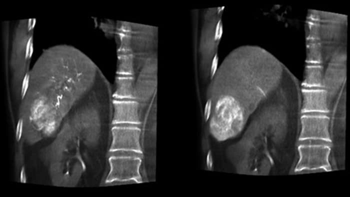 CBCT Dualによる最適な動脈と腫瘍の表示