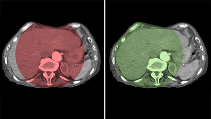 CBCT Openで肝臓全体を対象範囲に