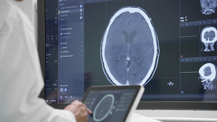 Ischemic stroke treatment