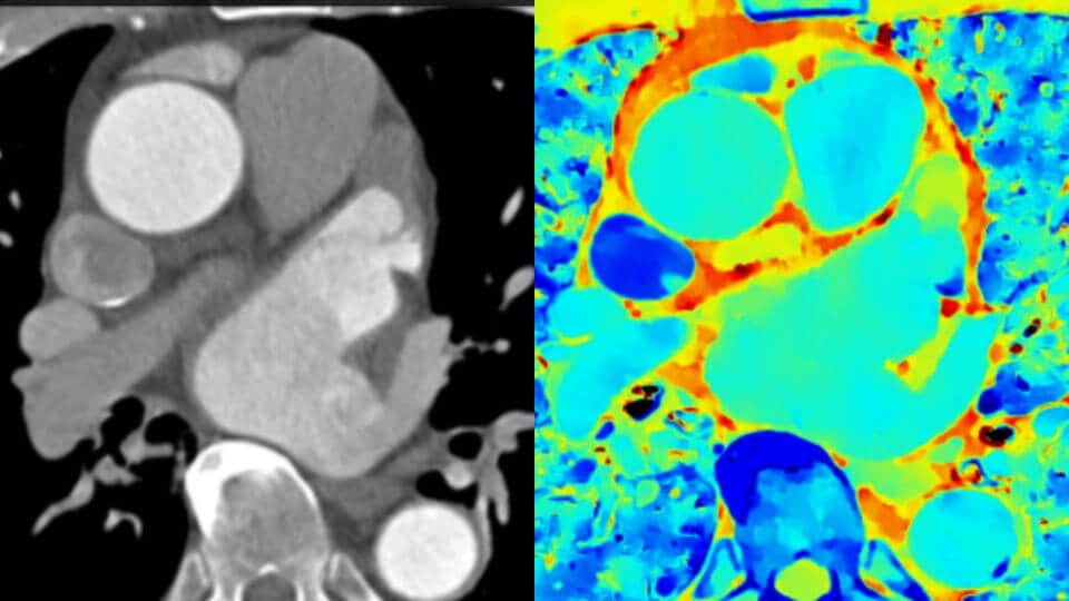 標準のCTの臨床画像と、スペクトラルディテクタCTの臨床画像との比較 image