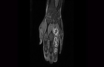 手 / 手首の腫瘍