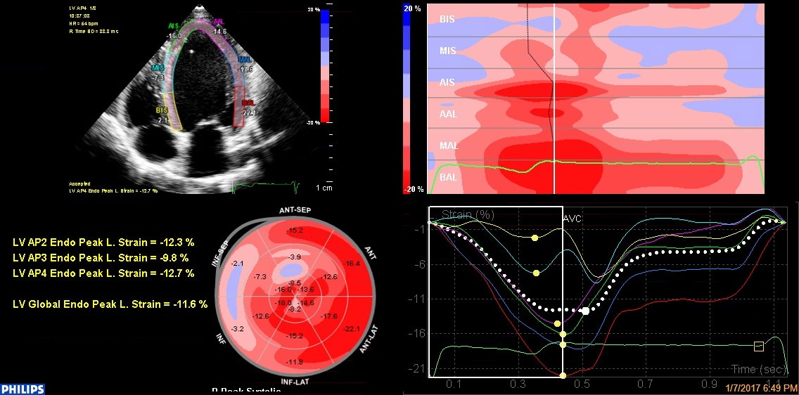 Philips Automated Cardiac Motion Quantificationの4分割表示