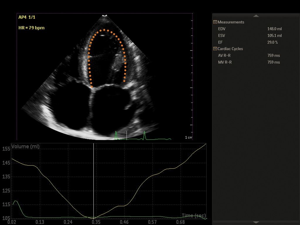Philips Automated 2D Cardiac Motion Quantification