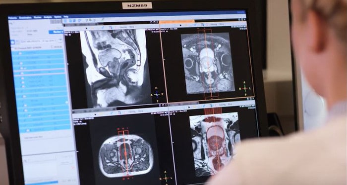 放射線治療ワークフローにおけるMRI