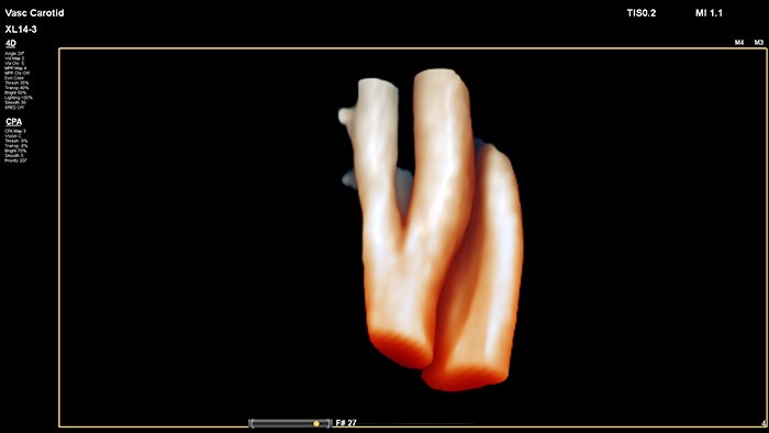 プラークの空間位置と組成を評価しやすく、3Dフローデータで狭窄や蛇行状態を評価できます