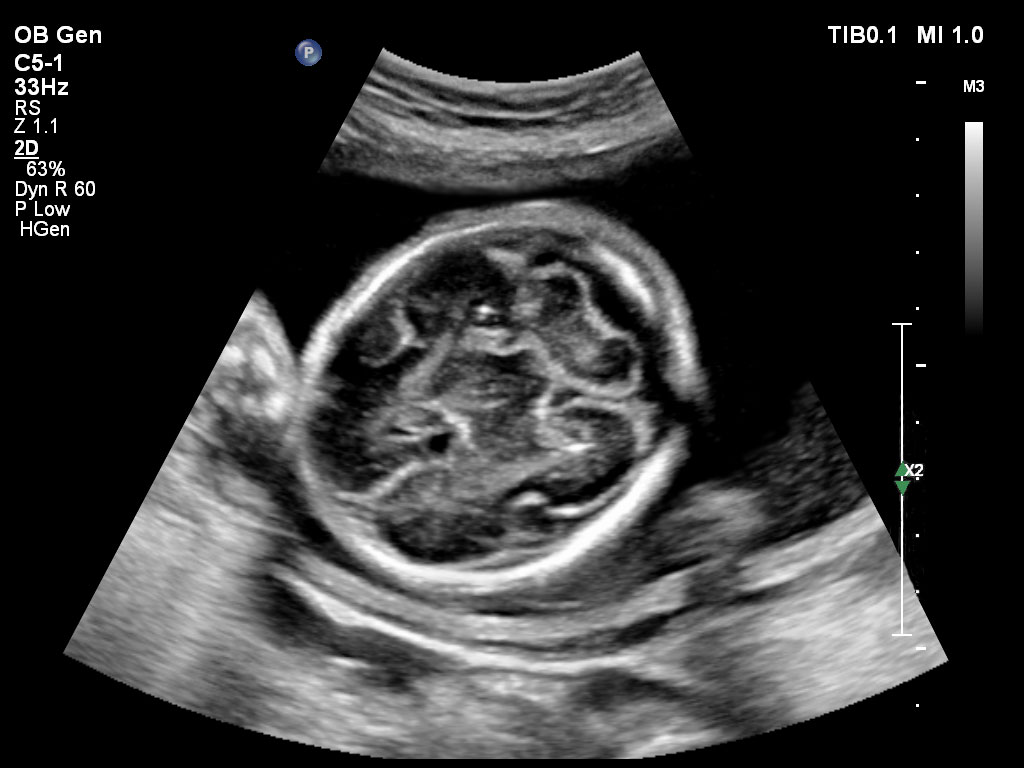 ultrasound first trimester image clinical