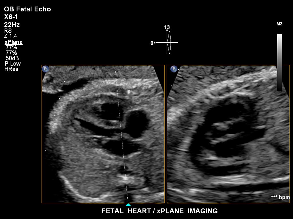 胎児の心臓 / xPlaneイメージング