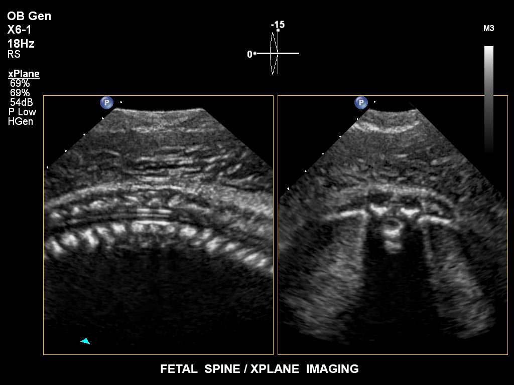 胎児の脊椎 / xPlaneイメージング