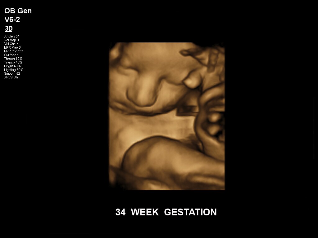 妊娠第34週
