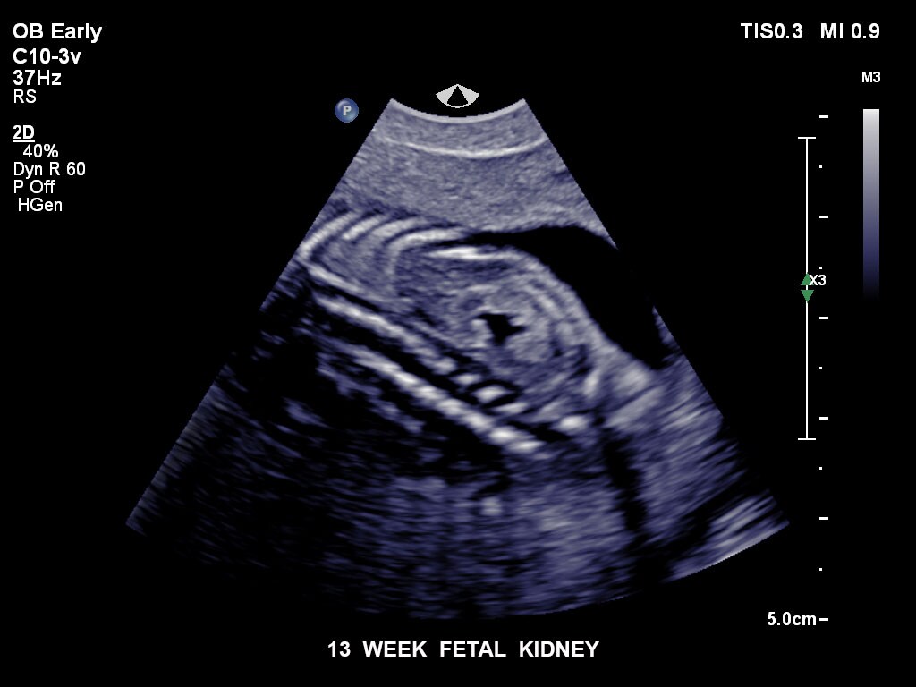 第13週の胎児腎臓