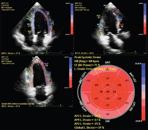 Automated Cardiac Motion Quantification