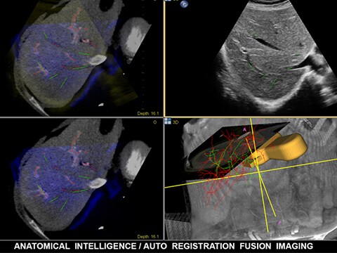 アナトミカルインテリジェンス / Auto Registrationによるフュージョン画像