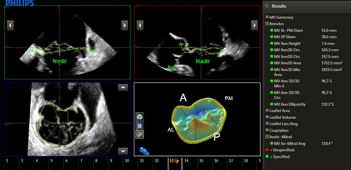 Mitral Valve Navigator