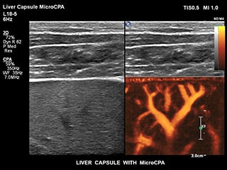 MCPAによる肝臓被膜