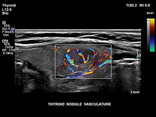甲状腺結節の脈管構造