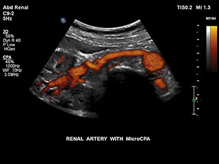 MCPAによる腎動脈
