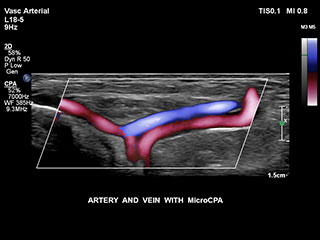 MCPAによる動脈と静脈