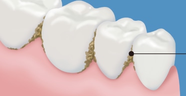 ネバネバのバイオフィルムである歯垢が歯の隙間に付いている図