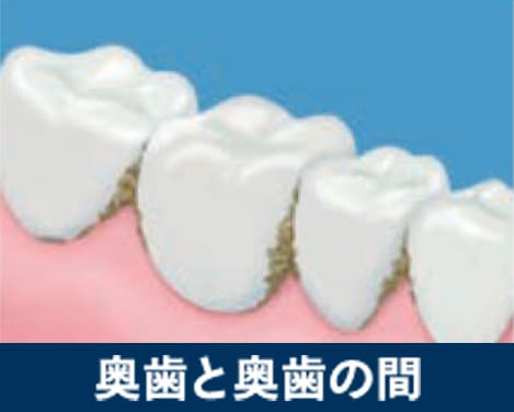 奥歯と奥歯の間に歯垢が溜まっているイメージ