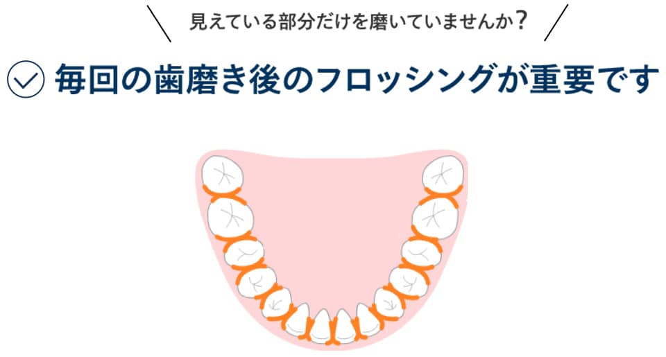 毎回の歯磨き後のフロッシングが重要。