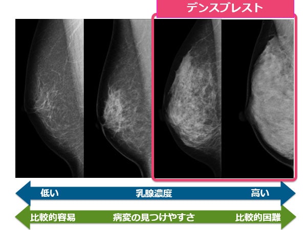 マンモグラフィでがんを見つけにくい乳房