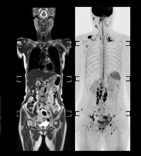 図3　T2強調画像(左)と拡散強調画像(右)でのWhole Body Imaging