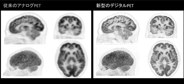 図4　アナログPET画像とデジタルPET画像の比較（同一被写体：頭頸部）