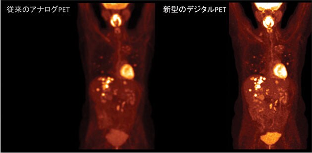 図5　アナログPET画像とデジタルPET画像の比較（同一被写体：体幹部）