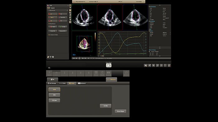 アナトミカル・インテリジェンス（AIUS）によるフルサイクルの心臓定量化（Dynamic HeartModelA.I.） （新しいウィンドウで開きます）