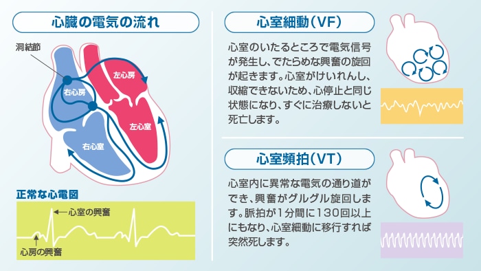 急性 心臓 死