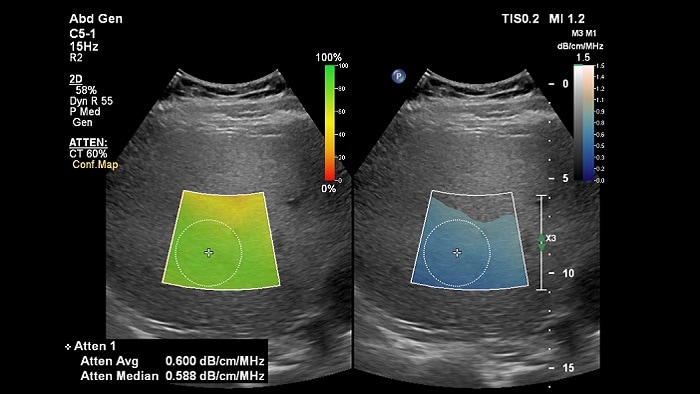 attenuation-imaging