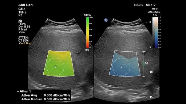 ultrasound-attenuation-imaging-assest2